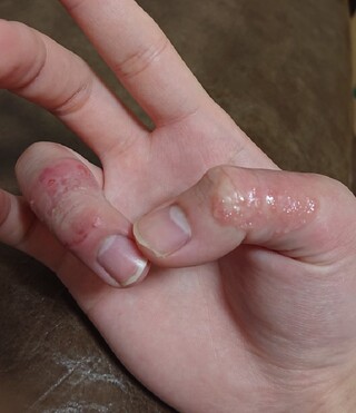 緊急 手湿疹 のような物が出来ています 画像 3日ほど前か Yahoo 知恵袋