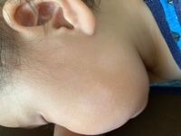 1歳の子供です 尋常性白斑でしょうか ほっぺ数カ所と目尻付近がこの Yahoo 知恵袋