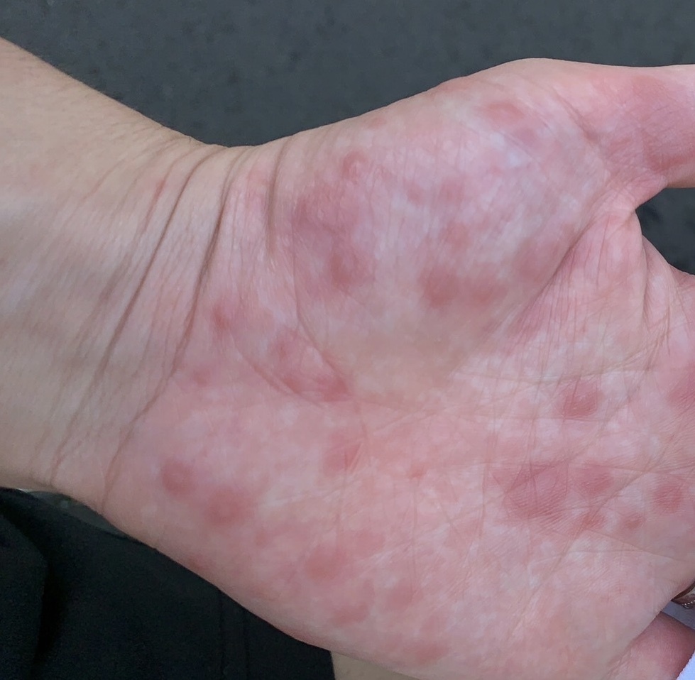 花粉症 アレルギー 解決済みの質問 Yahoo 知恵袋