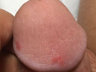 ぺ ニス 赤い 発疹 ピロリ菌の除菌薬で副作用 その赤い発疹 薬疹かも Shitomin Library