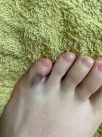 足の上にスマホ落としたらこのようになりました 小指折れていますかね？
痛いとかないです
あと、だんだん色が変わっててどす黒い色になってしまいました。