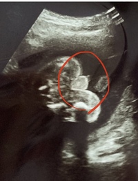 妊娠22週胎児の性別 エコー写真あり妊娠22週の検診のエコー写真です Yahoo 知恵袋