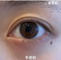 いきなり三重になりました 1年ほど前埋没法3点どめで二重整形をしました 朝起き Yahoo 知恵袋