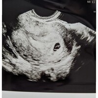 妊娠6w1dなのですが 始めての妊娠で知識がなくエコー写真が人と違うよ Yahoo 知恵袋