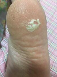 閲覧注意 足のかかとなのですが 白く丸く皮が浮いてきて 最近は Yahoo 知恵袋