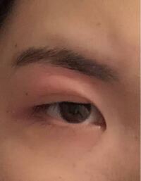 腫れる が 片目 まぶた 突然