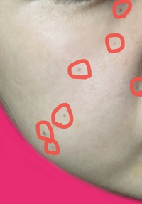 顔の片側にだけほくろが多いのはなぜでしょうか 代女子 Yahoo 知恵袋