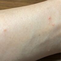 急に水膨れができました 虫刺されでしょうか それとも皮 Yahoo 知恵袋