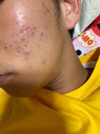 ニキビ跡が治りません ずっと赤いままでクレーターにはなっている物も Yahoo 知恵袋