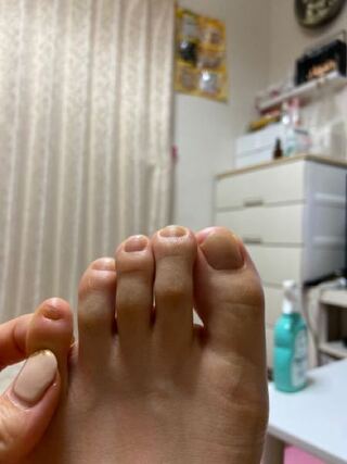 爪の形か コンプレックスです 私は昔から足の爪が汚いです 黄ばんでる Yahoo 知恵袋