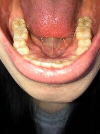 中１女子で銀歯が4本あるって異常でしょうか 銀歯がある女子はど Yahoo 知恵袋