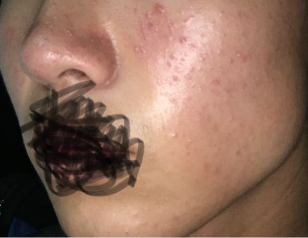 ニキビケア 回答受付中の質問 Yahoo 知恵袋