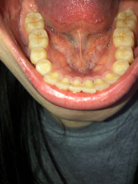 女 虫歯