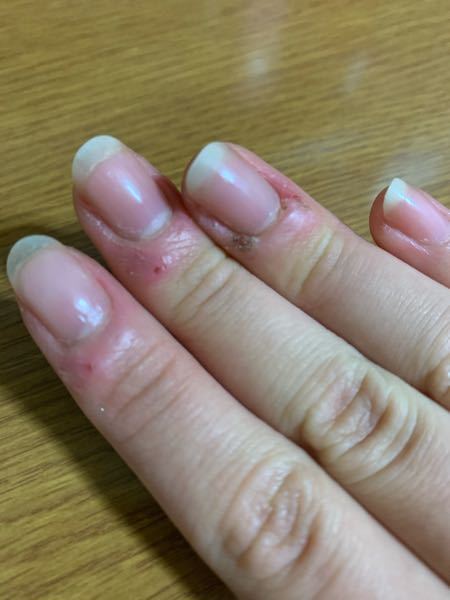 私は写真の様に指がボロボロです 写真では分かりにくい所もある Yahoo 知恵袋