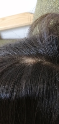 3歳の娘がおりますが 頭皮の真ん中らへんに１箇所髪がない所があります Yahoo 知恵袋