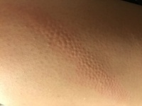 お風呂上がりやお酒を飲んだ時に このような湿疹が太ももの内側に出てきま Yahoo 知恵袋