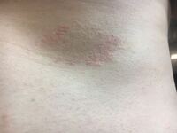 33歳男です 右乳首のcmほど下に湿疹ができてなかなか治りま Yahoo 知恵袋