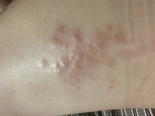 虫刺され いつのまにか写真のようなブツブツが出来てました 違和感あり Yahoo 知恵袋