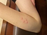 突然腕に赤い湿疹のようなものができました かゆいです ぷくっ Yahoo 知恵袋