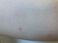 2日前の朝から右太もも内側に赤いプツプツが数カ所できました 今日になっ Yahoo 知恵袋