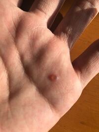 最近 知らないうちに手に透明な出来物っぽいのができてます Yahoo 知恵袋