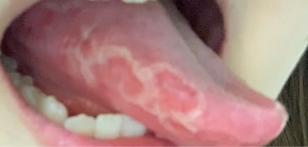 地図状舌 に関するq A Yahoo 知恵袋