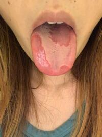舌の写真です 閲覧注意 たまに舌がこのようになるのですが 原因は何 Yahoo 知恵袋