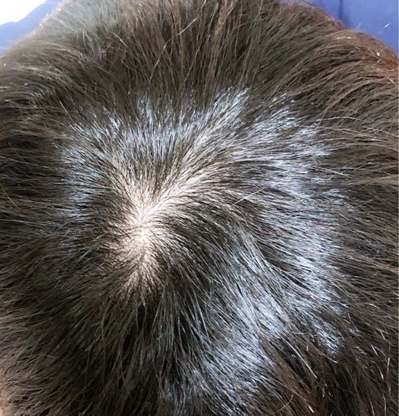 つむじが渦を巻いていなく 薄い気がするのですがヤバいですかね Yahoo 知恵袋