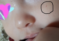 生後8ヶ月の子供の頬に 平らで赤いシミのようなものが出ました 表面もツ Yahoo 知恵袋