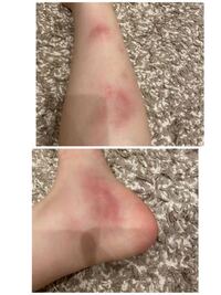 足の腫れは何科に行けばいいのでしょうか 足が写真のよう Yahoo 知恵袋