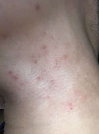 首に湿疹が出て治りません これは吹き出物でしょうか ダニでしょうか Yahoo 知恵袋