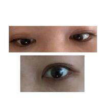 二重埋没をしたので 眼科で瞼をひっくり返す診察を拒否したいのですができ Yahoo 知恵袋