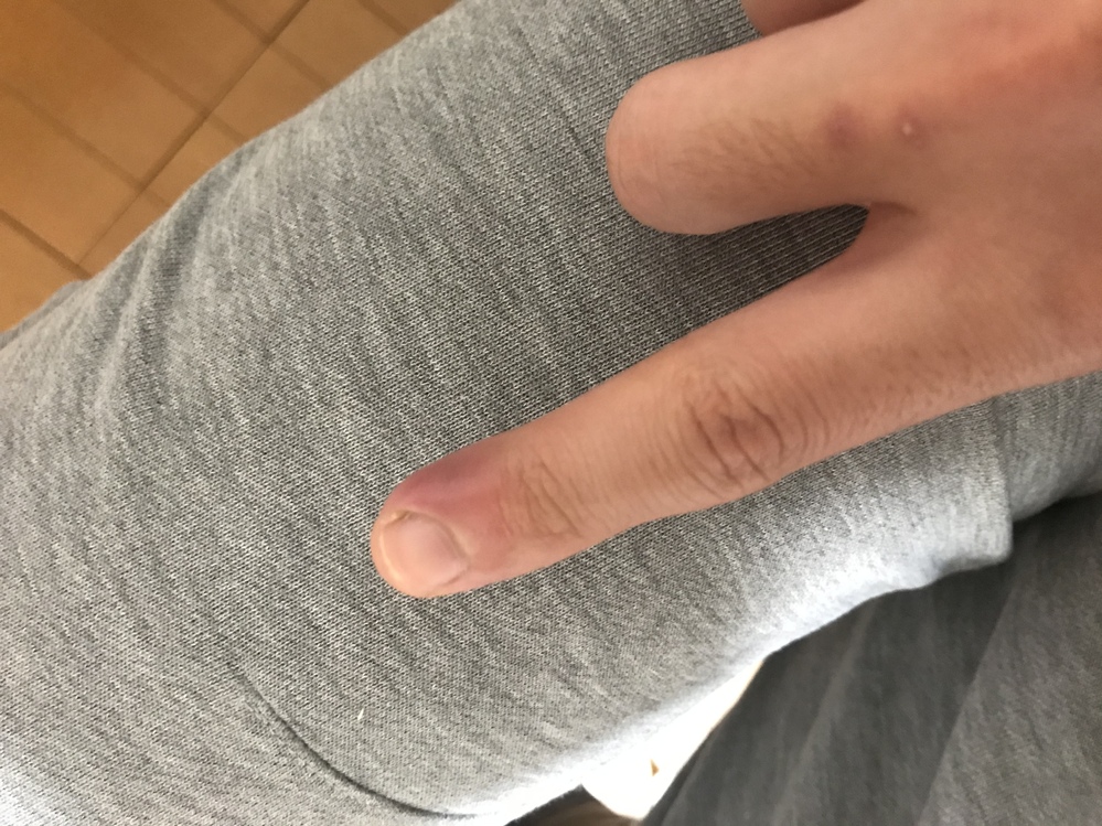 皮膚の病気 アトピー 解決済みの質問 Yahoo 知恵袋