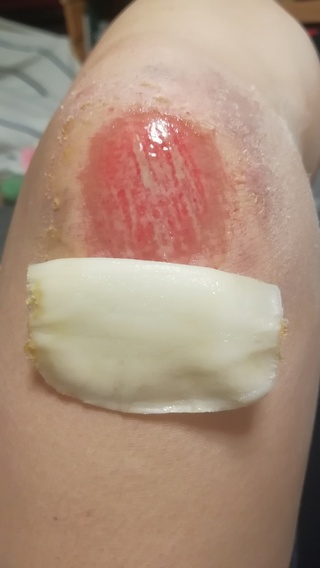 膿 キズパワーパッド