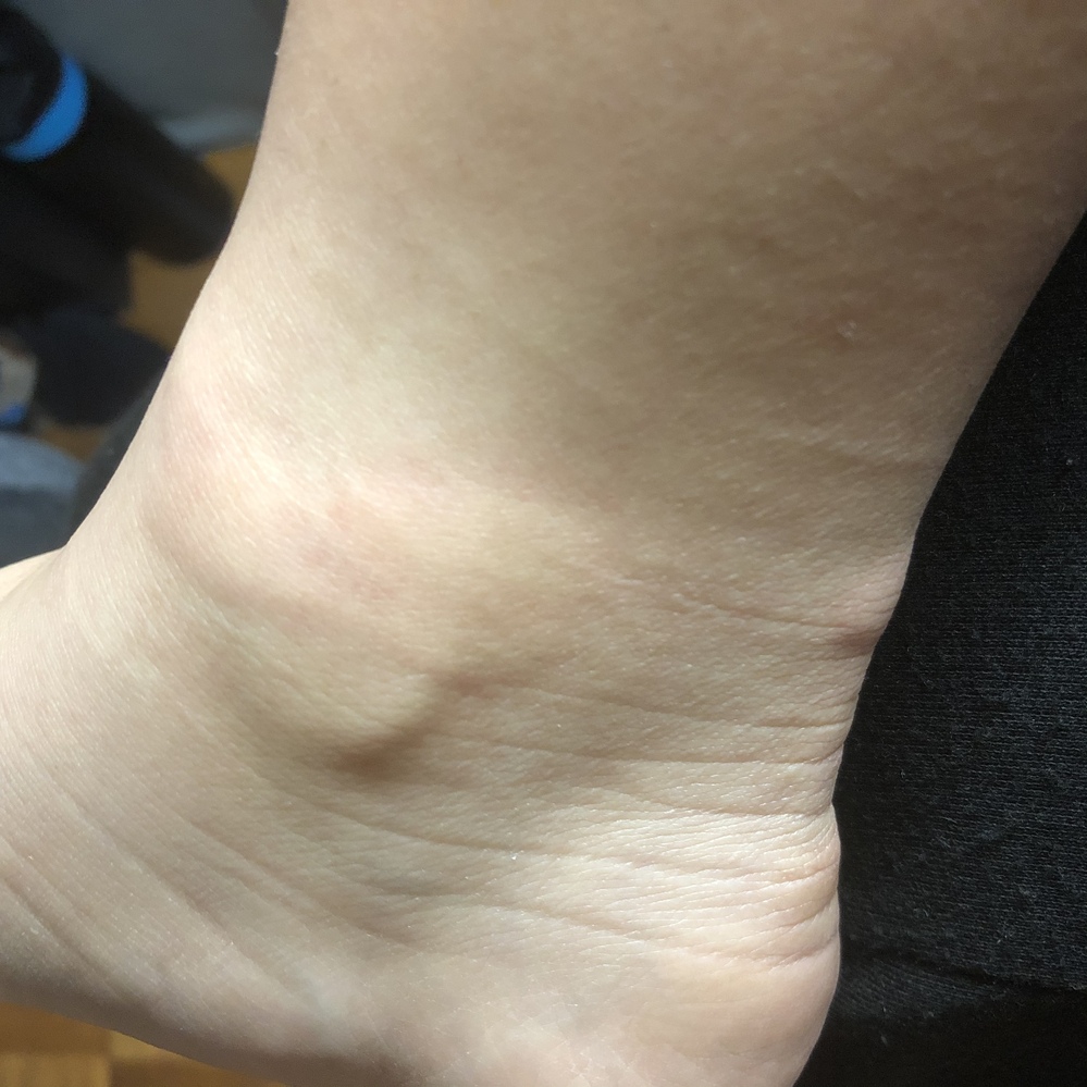 一定時間足を同じ向き お姉さん座りなど にしていたら腫れるのですがなに Yahoo 知恵袋