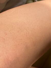 膝に埋没毛があります サロンの脱毛に通おうと思っている Yahoo 知恵袋