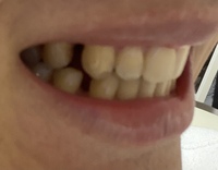 画像あり 歯科矯正をしてたのですが終了してリテーナーを作ったのですが Yahoo 知恵袋