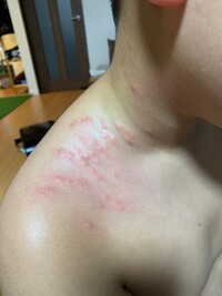 突然子供の首と肩の付け根のあたりにボコボコした発疹が出ました Yahoo 知恵袋