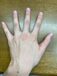 指の毛をいつもピンセットで抜いていたら 写真のように皮膚の下に Yahoo 知恵袋