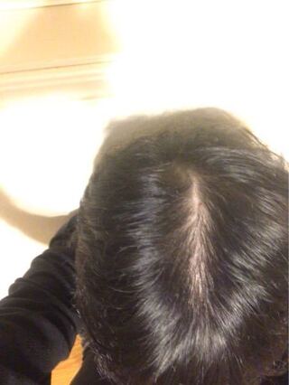 閲覧注意 現在浪人中の者です 最近髪の毛の抜ける量が尋常ではなく困っ Yahoo 知恵袋