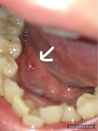 口の中の出来物についての質問です 先程昼食中に気付いた Yahoo 知恵袋