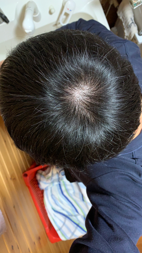 100以上 50 代 カッパハゲ に 似合う 髪型