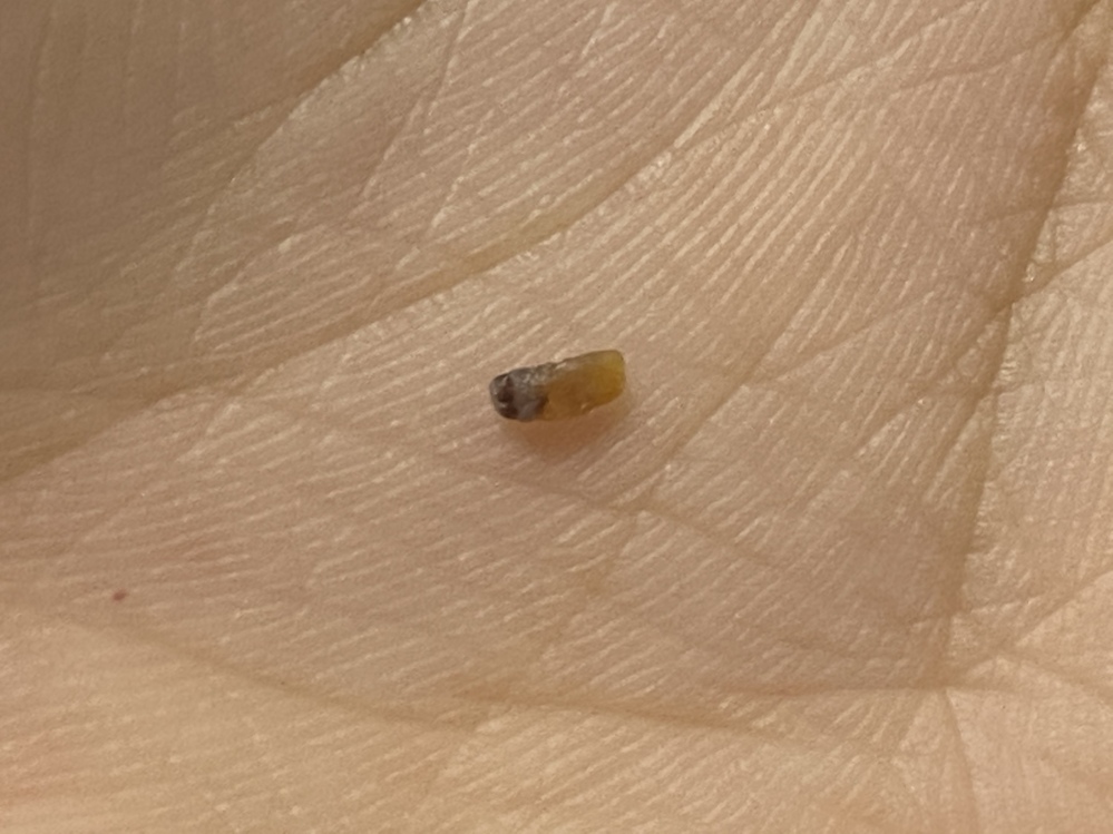 ずっと悩んでいます 背中に突然黒い物体が皮膚の中にあって押す Yahoo 知恵袋