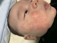 これは乳児湿疹でしょうか 元々ほっぺの膨らみには湿疹に Yahoo 知恵袋