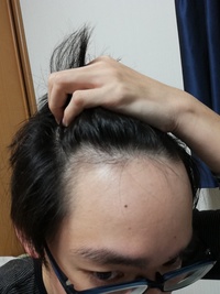 おでこが広すぎて悩んでます 元々おでこは広かったのですが最近更に広く Yahoo Beauty
