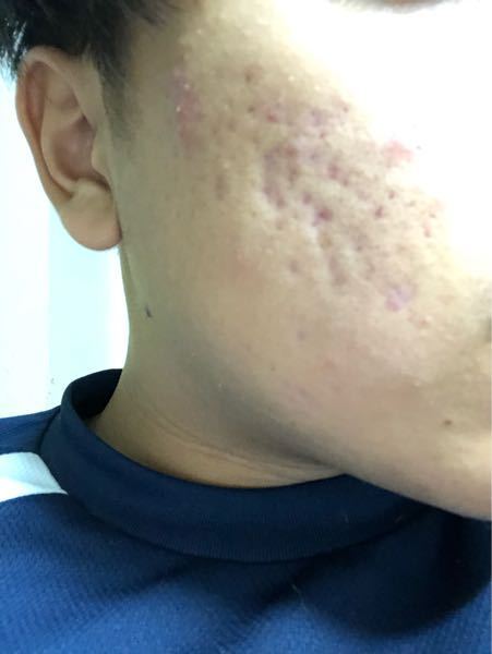 ニキビとニキビ跡治したいです 今こんな感じですいい方法ありません Yahoo 知恵袋