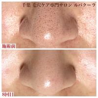 助けてください 鼻の角栓とりがやめられません 鏡を見てニュルと出してしまい Yahoo 知恵袋