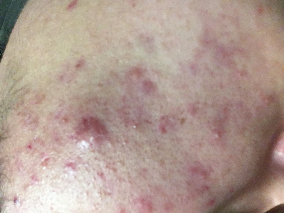 ニキビケア 解決済みの質問 Yahoo 知恵袋