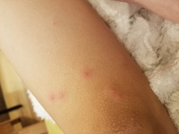 2日前から子供の足 大腿 膝の周囲 に赤い湿疹が出来ました Yahoo 知恵袋