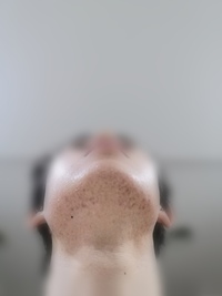 19才男です 顎下の赤い斑点で悩んでいます 6月頃からはあったと思いま Yahoo 知恵袋